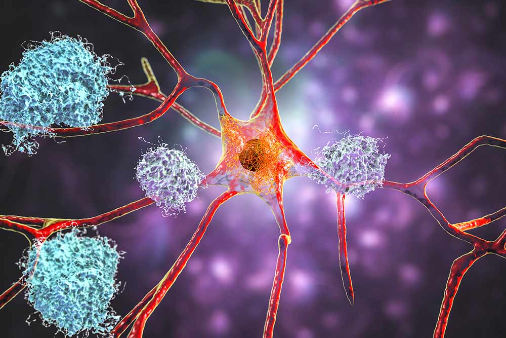 Illustration showing amyloid plaques in brain tissue.